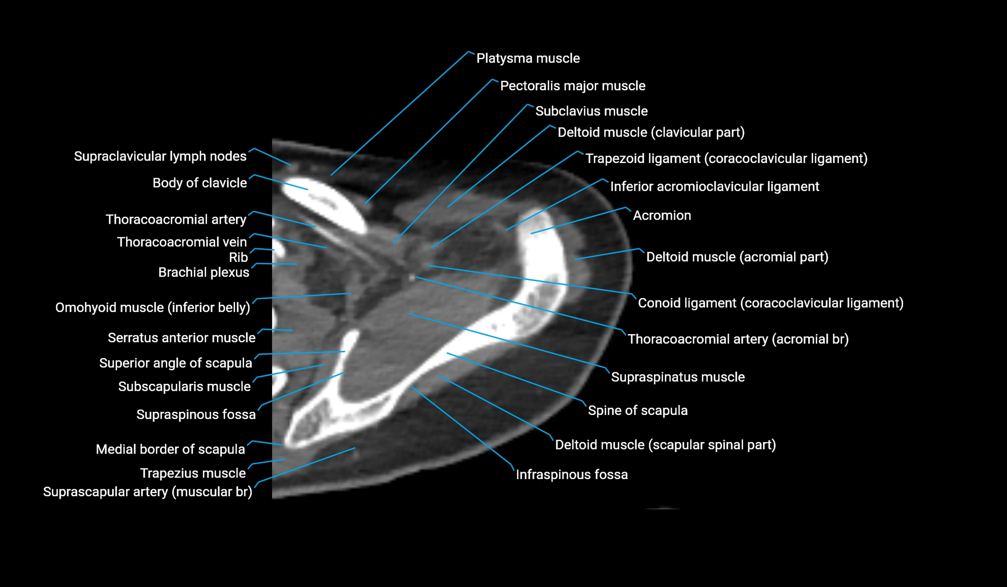 CT upper arm axial  cross sectional anatomy labelled radiology image -00068.webp